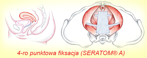 4-punktowa fikasacja